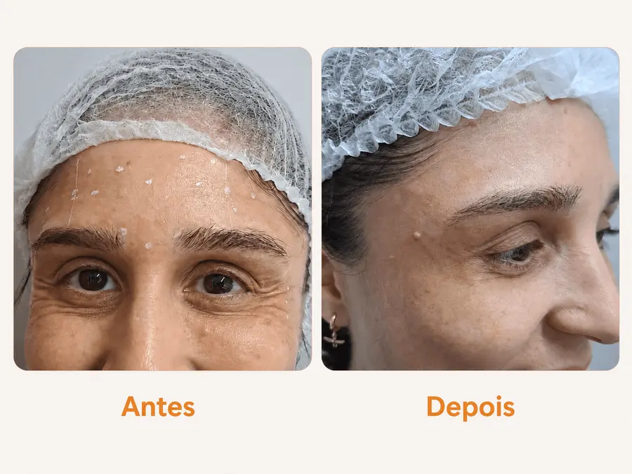 Antes e depois de Botox na Shiva Zen — Suavização das linhas de expressão