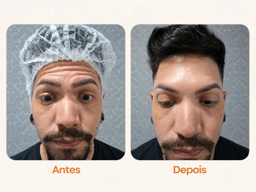 Antes e depois de Botox na Shiva Zen — Resultado masculino